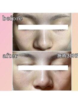 プリマジュール/毛穴汚れ、たるみ改善