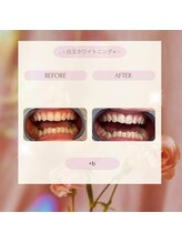 プラスビー 2号店(+b)/ホワイトニングビフォーアフター