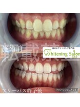 ホワイトニングサロン 広島店/【ホワイトニング施術例】