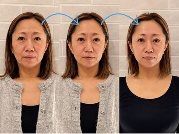 ネルジム 札幌店(NERU GYM)の写真/ほうれい線・たるみを徹底改善！ハリ感と引き締まりを実感◎透明感と若々しさを引き出すケアで自信UP☆
