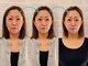 ネルジム 札幌店(NERU GYM)の写真/ほうれい線・たるみを徹底改善！ハリ感と引き締まりを実感◎透明感と若々しさを引き出すケアで自信UP☆