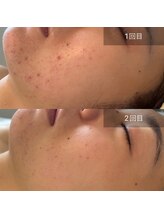 ビューティリュクス(beauty luxe)/DT無しハーブ/マスク肌荒れに！