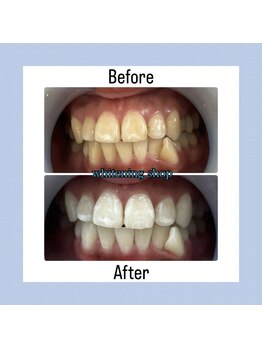 ホワイトニングショップ 今治店/40分×10回Before/After