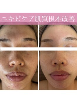 ミエル(miel)/【ハーブピーリング】ニキビケア