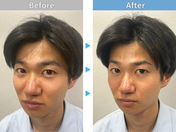 マユクリア 埼玉大宮店/美眉B/A [眉毛/眉毛サロン/大宮]