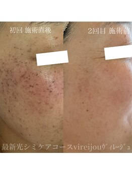 プライベートアイラッシュサロン ヴィレージュ 稲毛店(Vireijou)/大人気のシミケアで悩み解決！