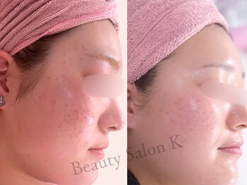 ケイ(K)/《跡・毛穴・ニキビ》が気になる