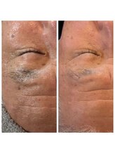 ディープブルー(Deep Blue)/プラペンデュアル施術