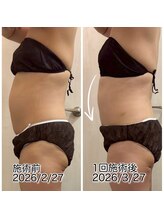 クールスパ(COOL SPA)/40代女性お腹症例