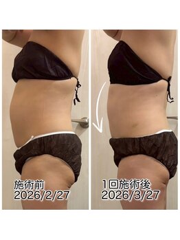 クールスパ(COOL SPA)/40代女性お腹症例