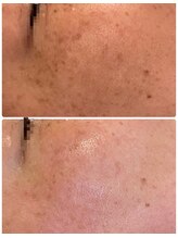 ジャスミン(Jasmin)/プラペン×幹細胞