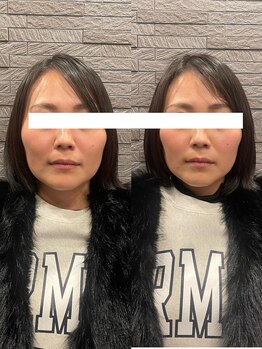 長寿鍼灸院 長寿整骨院/美容鍼50本の効果★小顔効果