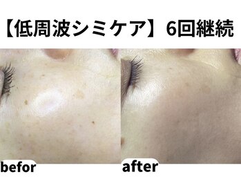 ティエル 高崎店(Tiele)/【え?シミどこいった?】