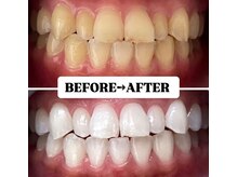 ホワイトニングサロン 豊中/Before&After美白ホワイトニング