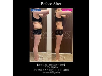 エキュレ ジャーニー トゥ マイ トータル ビューティー(equrer)/約半年で