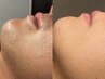 8月限定★目指せモテ肌男★MENS脱毛10%OFF