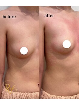 ラヴィス(ravis)/上向きの理想のバストに!