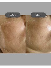 シイ(total skin beaute sii)/50代　広がるシミ改善