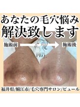 ピュール 鯖江店(PUR)/毛穴/毛穴ケア/毛穴洗浄