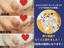 ベリル(BERYL)/シミとり放題　施術1回目