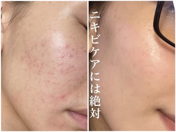 ミーラヤ(MILAYA)/梅田毛穴/梅田リアボーテ