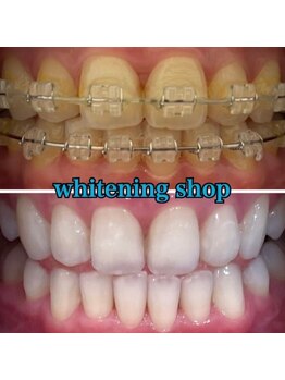 ホワイトニングショップ 本八幡店/Before&After美白ホワイトニング