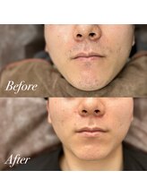 メンズ脱毛サロン ボス(BOSS)/【メンズ脱毛/ヒゲ脱毛】清潔感