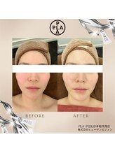 ココ センガ ビューティー クリニック(COCO SENGA Beauty-Clinic)/韓国肌管理プラピール効果写真