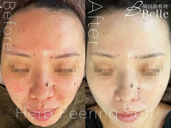 ベル 下北沢(Belle)/ハーブピーリング｜ニキビケア