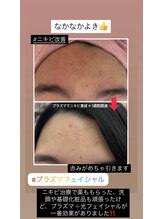 顔凛(カオリン)/プラズマフェイシャルニキビ改善