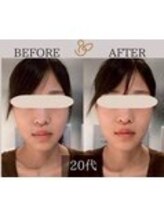 チョコバリ 錦糸町店(chocobari)/小顔×リフトアップ(美容鍼)20代