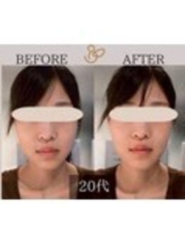 チョコバリ 錦糸町店(chocobari)/小顔×リフトアップ(美容鍼)20代