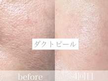 エテブラン(ete blanc)の雰囲気(たるみ毛穴の引き締めにはピーリング)