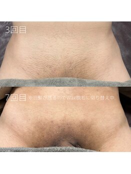 カナウ(KANAU)/VIO脱毛（40代前半男性）