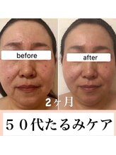 エテルネル(eternel)/エラスチン