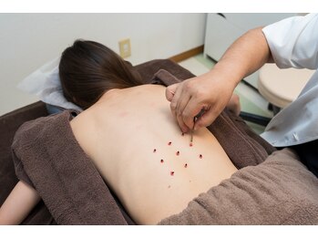 たかはし治療院/冷えにはお灸も使用します