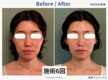 グロウズ(Glows)/頬コケ/顎のもたつきも改善