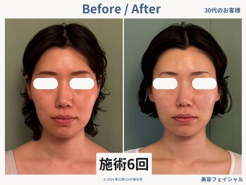 グロウズ(Glows)/頬コケ/顎のもたつきも改善