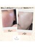 【毛穴落ちストップ！】徹底毛穴レスフェイシャル！￥16,000