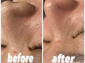 フルール(Fleur)/◆毛穴洗浄/毛穴レス/黒ずみ◆