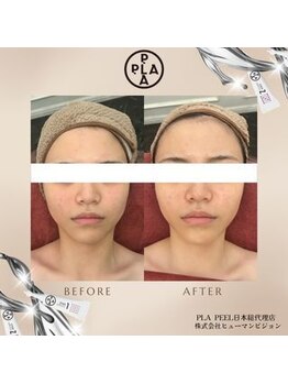 ココ センガ ビューティー クリニック(COCO SENGA Beauty-Clinic)/韓国肌管理プラピール効果写真