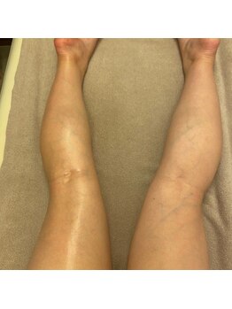 ラヴィアンローズ/脂肪分解にはキャビテーション☆