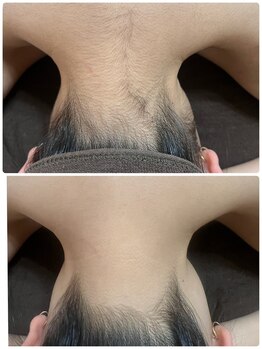 シャイン(shine)/うなじスッキリ