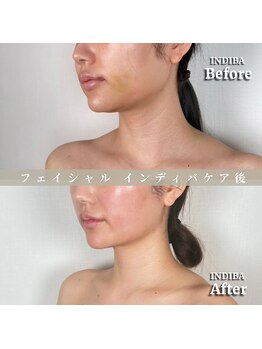 術後の女神 大阪心斎橋店/術後ケアインディバ・インディバ