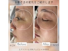 アネーロ(Anhelo)の雰囲気（4回目ビフォーアフター♪くすみがケアされました!!｛くすみ/クマ）