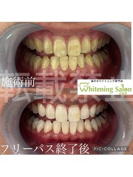 ホワイトニングサロン 広島店/【ホワイトニング施術例】