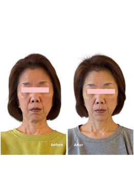 ニコディア(nico-dia)/美容鍼