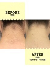 シール(Syl)/うなじ脱毛