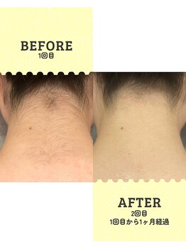 シール(Syl)/うなじ脱毛