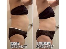 クールスパ(COOL SPA)/40代女性お腹症例